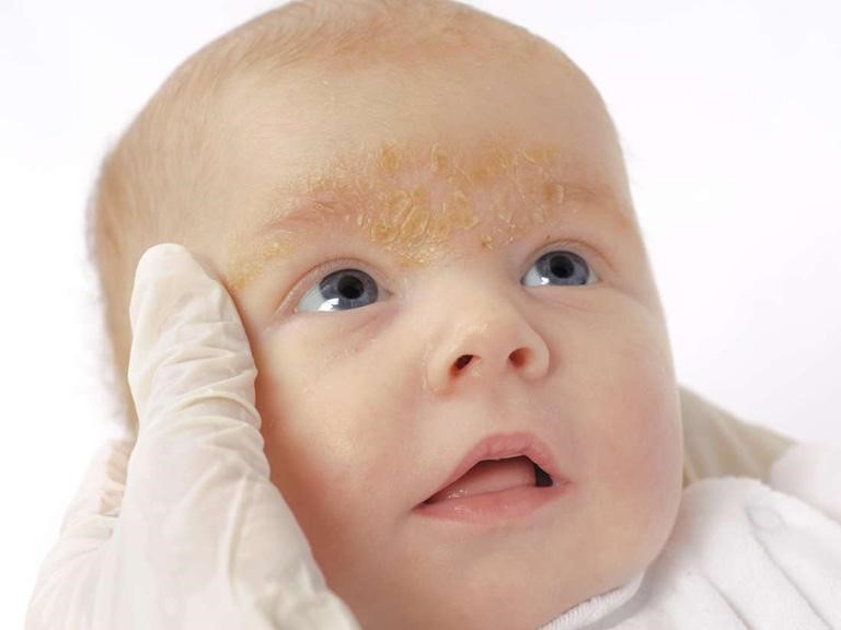 Da khô sẽ làm em bé cảm thấy khó chịu, da bong tróc mẩn đỏ nếu cha mẹ không có biện pháp chăm sóc kịp thời