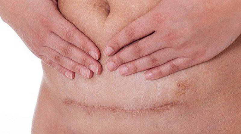 Theo dõi vết mổ nếu nhận thấy những điều bất thường cần có phương pháp khắc phục phù hợp