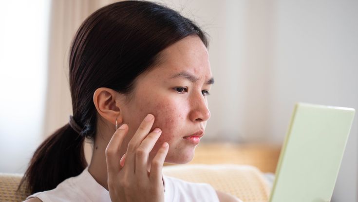 Xuất hiện mụn hoặc da sạm đi Xuất hiện mụn hoặc da sạm đi